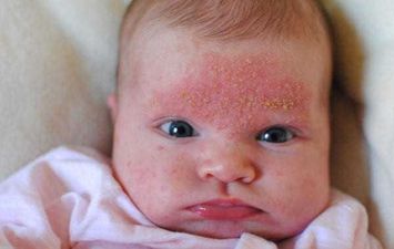 علام تدل البقع الجلدية الحمراء لدى الأطفال؟