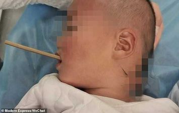 طفل ينجو من الموت بعد اختراق عصا لحلقه بطول 20 سم