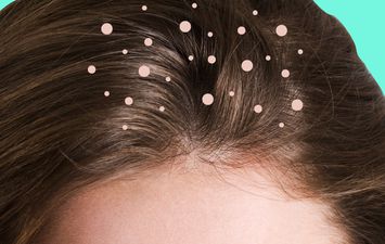 علاجات طبيعية تخلصك من قشرة الشعر في الشتاء 