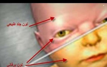 أعراض الصفراء عند الرضع