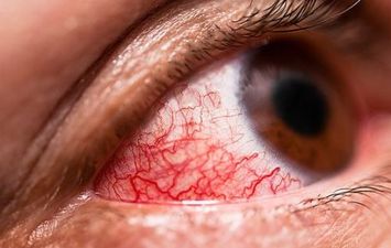 تأثير نقص فيتامين د على العين