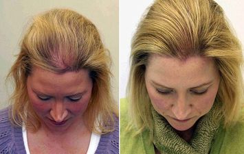 عوامل نجاح عملية زراعة الشعر