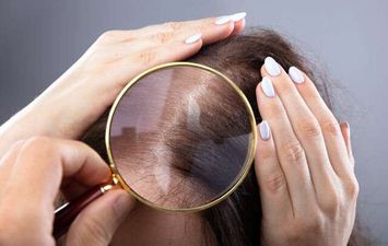 علاج قشرة الشعر  في الصيف