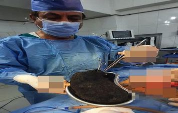 استخراج 3 كيلو شعر من معدة 