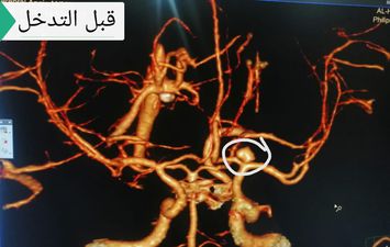 عملية قسطرة مخية بجامعة سوهاج