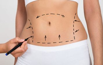 أنواع عمليات  شفط الدهون 