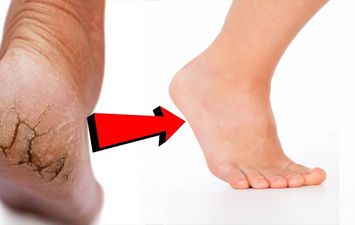 علاج تشقق القدمين باستخدام الخل 