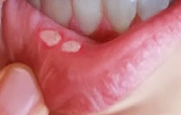  فطريات الفم