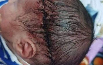 إصابة طفل حديث الولادة بقطع فى الرأس أثناء إجراء ولادة قيصرية 