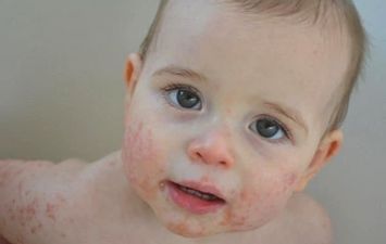 الطفل المصاب بالتهاب الجلد التأتبي