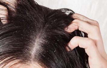 علاج القشرة في الشعر 