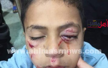 إصابة طفل بصاروخ في عينيه بالفيوم
