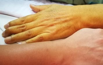 زراعة الجلد