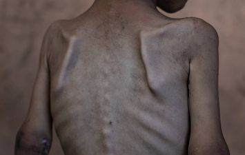 عظام طفل من غز برزت بسبب الجوع