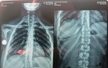 ابتلاع دبوس 