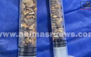 استخراج حصاة بطول 7 سم من كلى مريض بمستشفى دسوق العام  