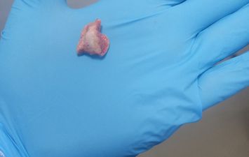 استخراج زلطة من المرئي لطفل 