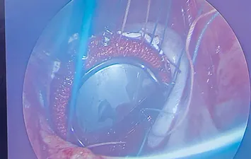 جانب من العملية الجراحية 