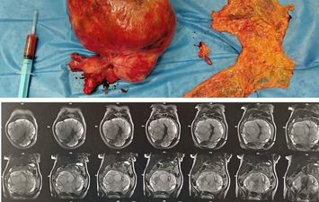 جانب من العملية الجراحية 