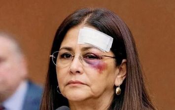 سيدة فنزويلا الأولى وعلى وجهها آثار العنف