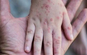 جدري القرود