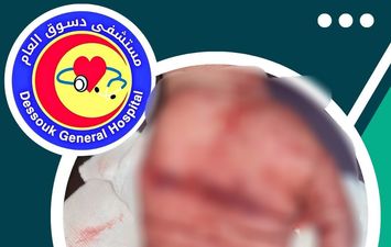 أطباء مستشفى دسوق العام ينقذون يد مريض من البتر 