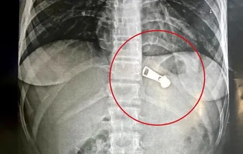 استخراج جسم معدني من معدة طفلة بمستشفى دسوق العام