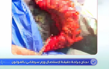 أطباء مستشفى دسوق العام ينجحون في استئصال ورم سرطانى بالقولون  لمريض