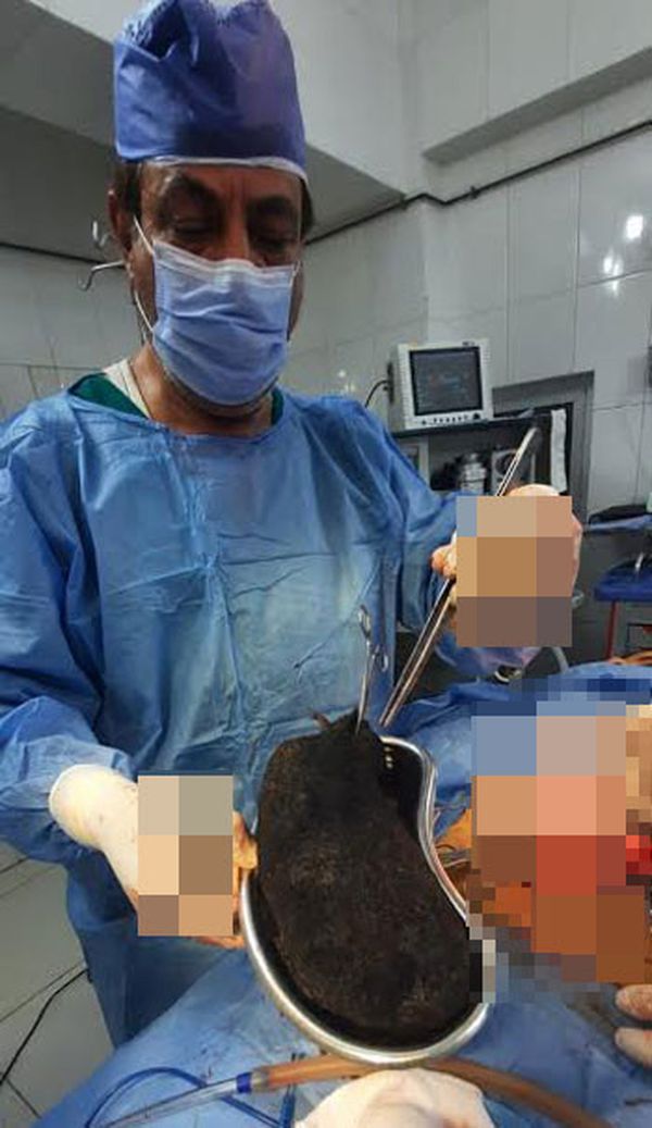 استخراج 3 كيلو شعر من معدة 