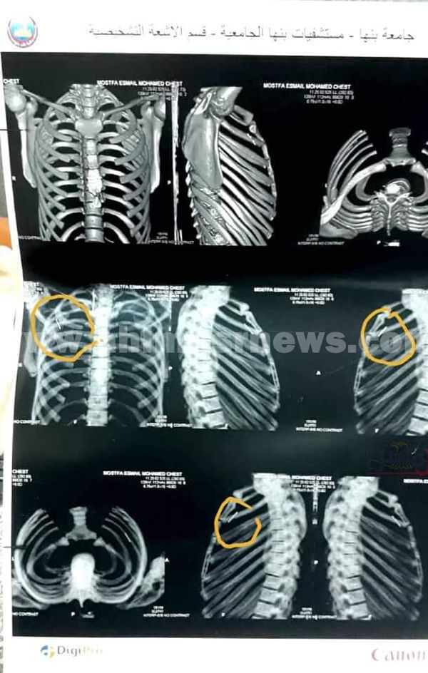 استخراج الدبوس 