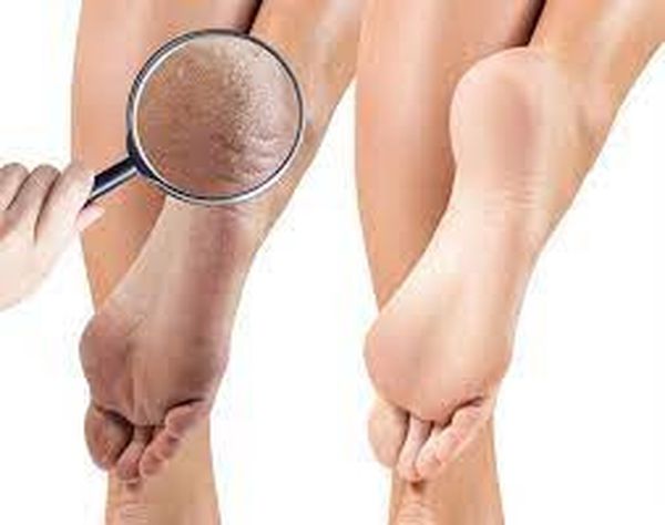 علاج تشقق القدمين باستخدام الخل 