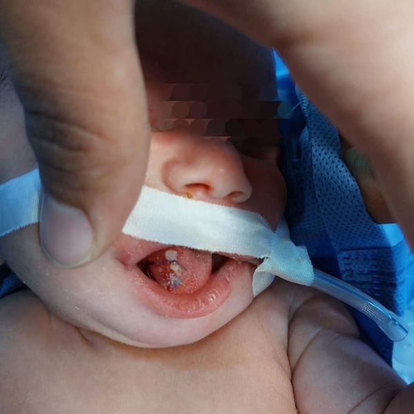 مستشفى مطروح العام تجري جراحية دقيقة لاستئصال ورم من فم طفلة 