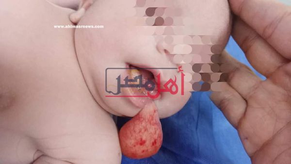 مستشفى مطروح العام تجري جراحية دقيقة لاستئصال ورم من فم طفلة 