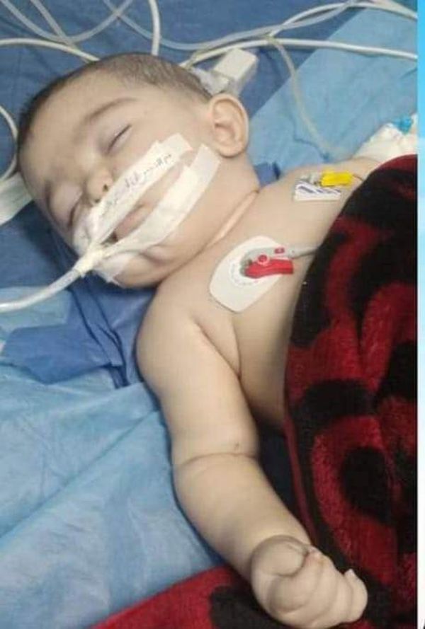 الطفل محمد المصاب بكسر بالجمجمة 