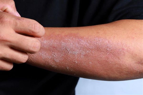 أمراض جلدية في فصل الصيف