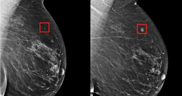 ابتكار روبوت أمهر من الأطباء في الكشف عن سرطان الثدي