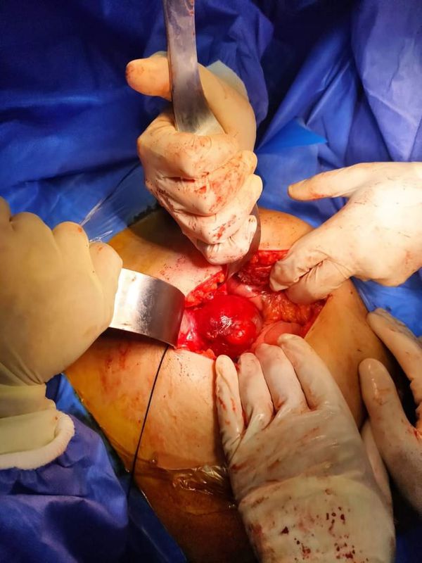 عملية جراحية بمستشفى بنى سويف التخصصي لاستئصال تكيس متشعب بالكبد 