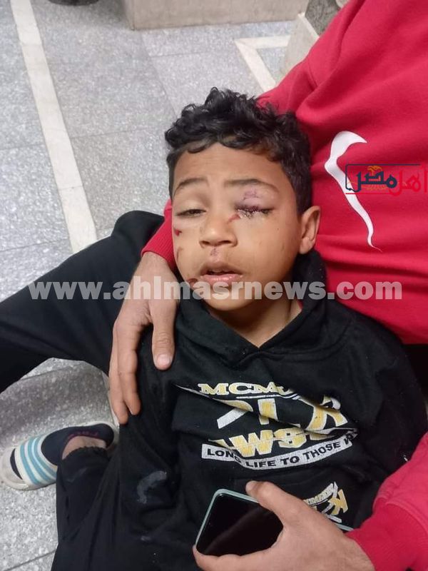 إصابة طفل بصاروخ في اعينه بالفيوم