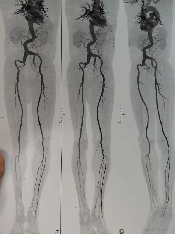 إجراء جراحة دقيقة ومعقدة لإصلاح تمدد ضخم بالشريان الأورطي البطني 