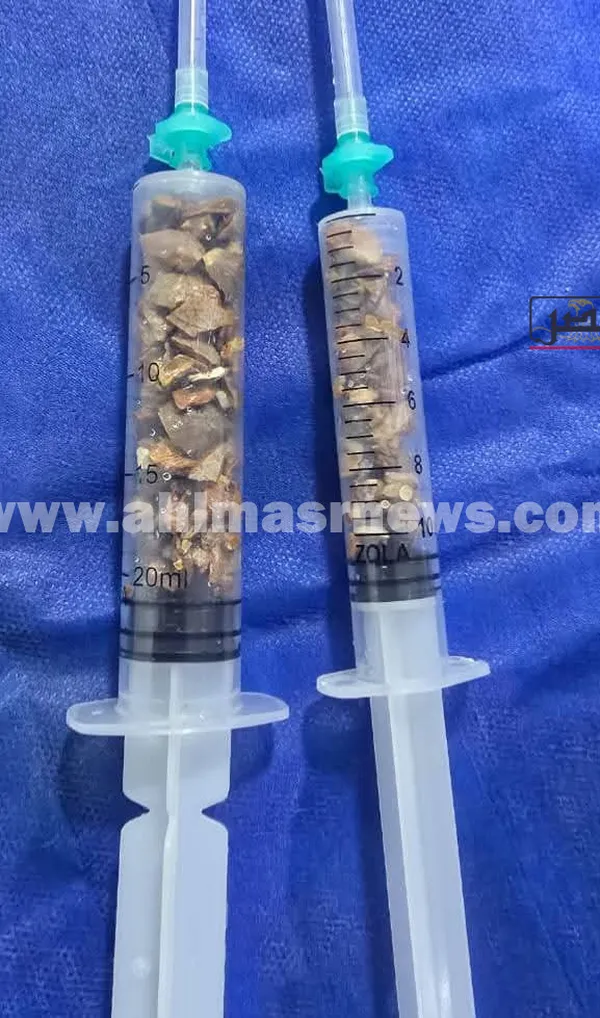 استخراج حصاة بطول 7 سم من كلى مريض بمستشفى دسوق العام  