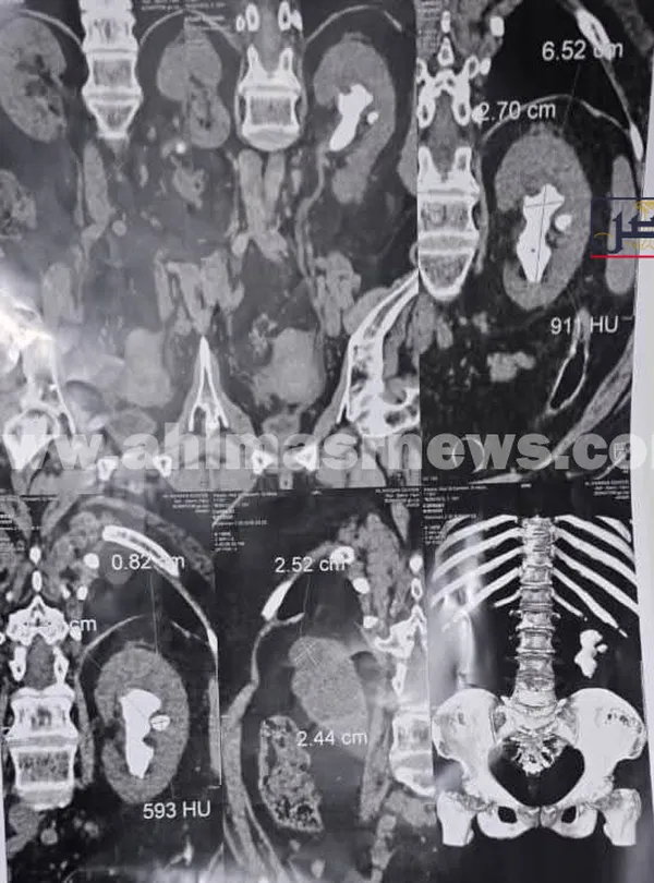 استخراج حصاة بطول 7 سم من كلى مريض بمستشفى دسوق العام  