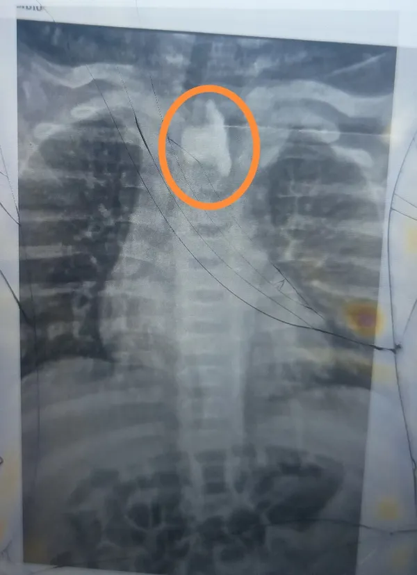 استخراج زلطة من المرئي لطفل 