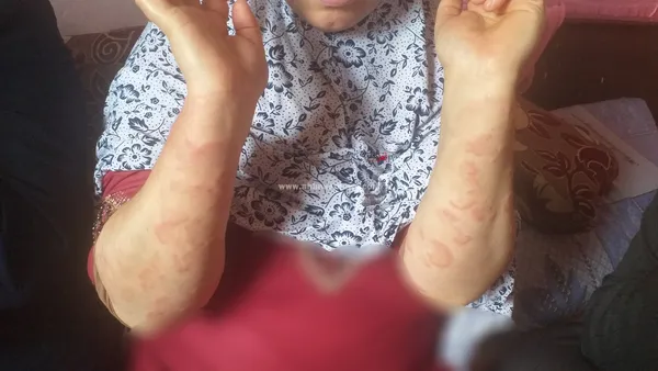 الحساسية الجلدية التي تعاني منها عايدة 