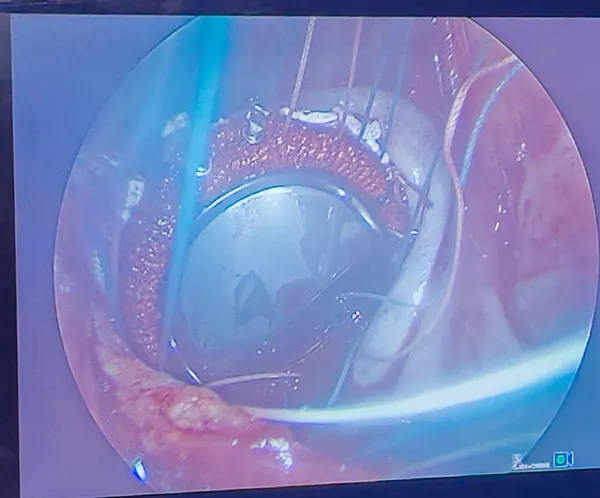 جانب من العملية الجراحية 