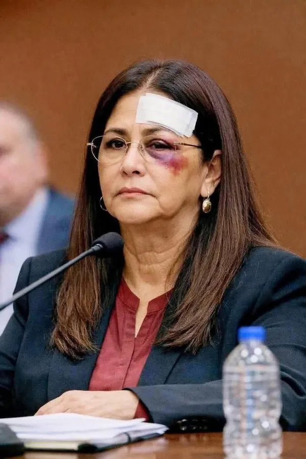 سيدة فنزويلا الأولى وعلى وجهها آثار العنف