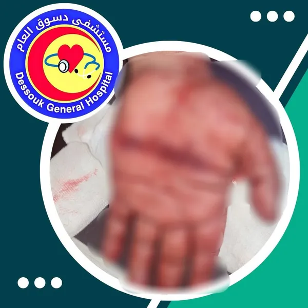أطباء مستشفى دسوق العام ينقذون يد مريض من البتر 
