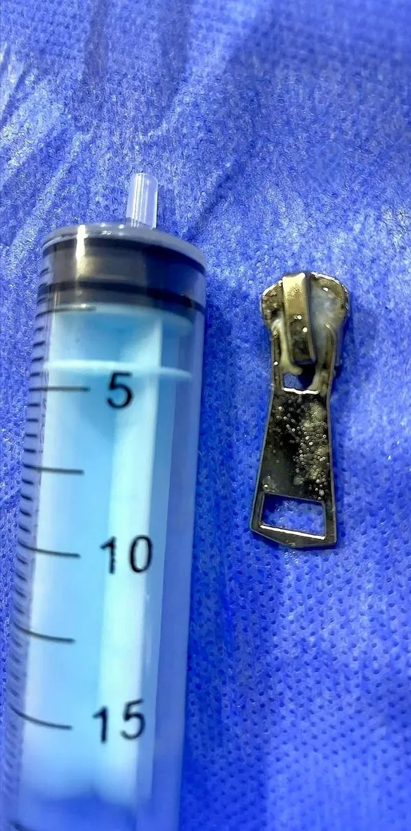 بعد 7 أيام من المعاناة.. استخراج جسم معدني من معدة طفلة بمستشفى دسوق العام