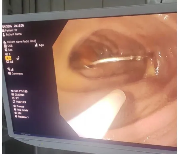 بلع مسمار.. فريق طبي بمركز كبد كفر الشيخ يستخرج جسمًا حادًا من أمعاء صغير