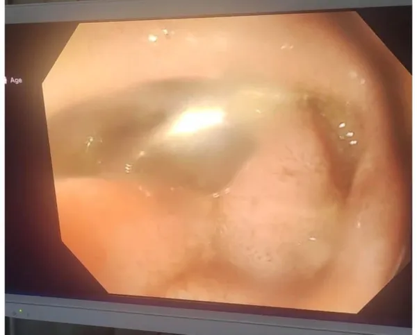 بلع مسمار.. فريق طبي بمركز كبد كفر الشيخ يستخرج جسمًا حادًا من أمعاء صغير