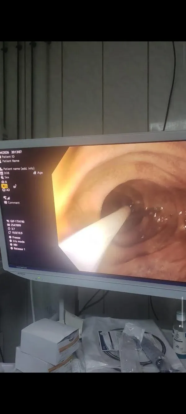 بلع مسمار.. فريق طبي بمركز كبد كفر الشيخ يستخرج جسمًا حادًا من أمعاء صغير